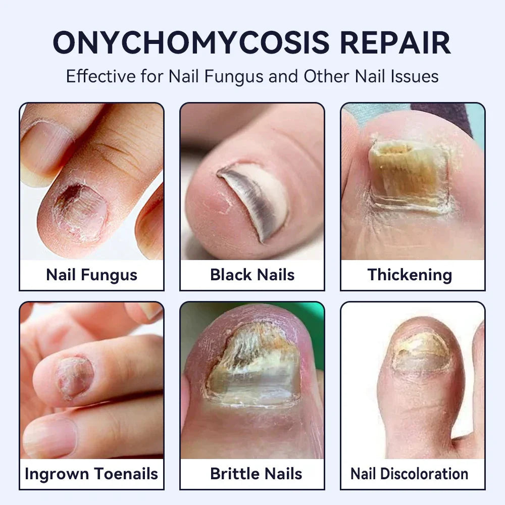 Close-up of human nails showing fungal infections, nail thickening, discoloration, and brittleness.