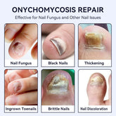 Close-up of human nails showing fungal infections, nail thickening, discoloration, and brittleness.