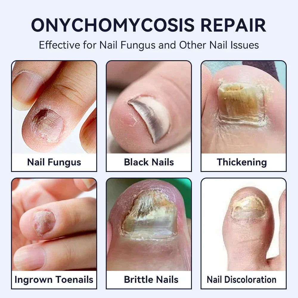 Close-up of human nails showing fungal infections, nail thickening, discoloration, and brittleness.