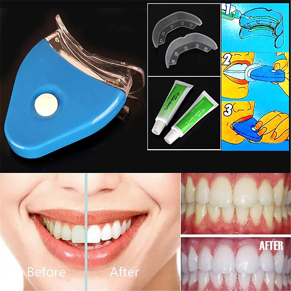 Teeth whitening kit with mouth trays, gel tubes, user instructions, and before-after smile results